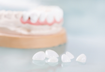 Veneers Cost Per Tooth — What You Need To Know