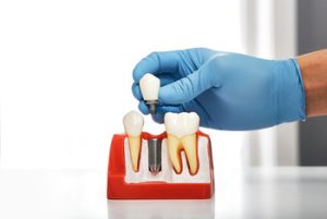 cheap dental implant reasons pennant hills