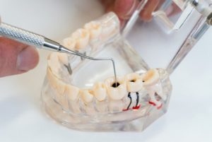 Root Canal vs Extraction treatment
