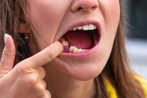 50 Soft Foods to Eat After Tooth Extraction recovery