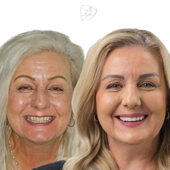 Beyond 32 Dental Before and after case 1 Anna Banovic