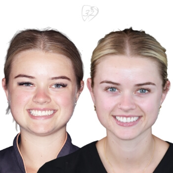 Beyond 32 Dental Before and after case 1 -Emily B
