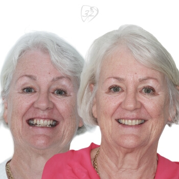 Beyond 32 Dental Before and after case  2 - Anne F