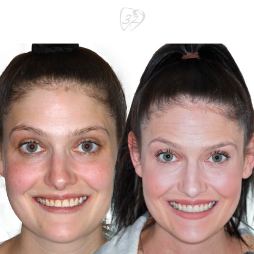 Beyond 32 Dental Before and after case 2 -Emily Page