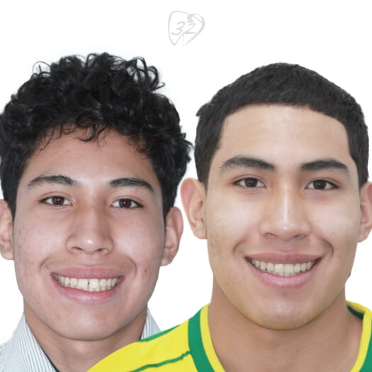 Beyond 32 Dental Before and after case 3 - David Mendoza