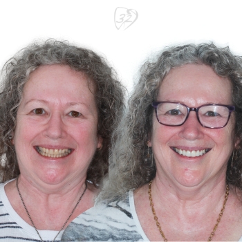 Beyond 32 Dental Before and after case 3 - Karen Daily