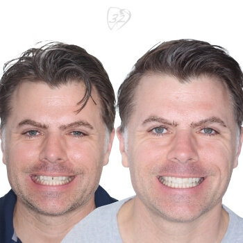 Beyond 32 Dental Before and after case 4 - Kurt
