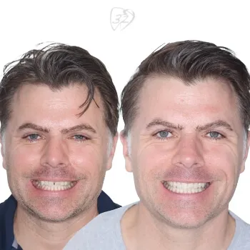 Beyond 32 Dental Before and after case 4 - Kurt