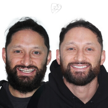 Beyond 32 Dental Before and after case 4 - Luke