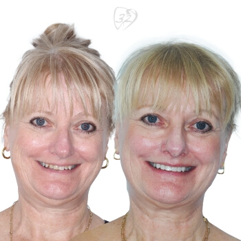 Beyond 32 Dental Before and after case 5 - Janet Kalotheos