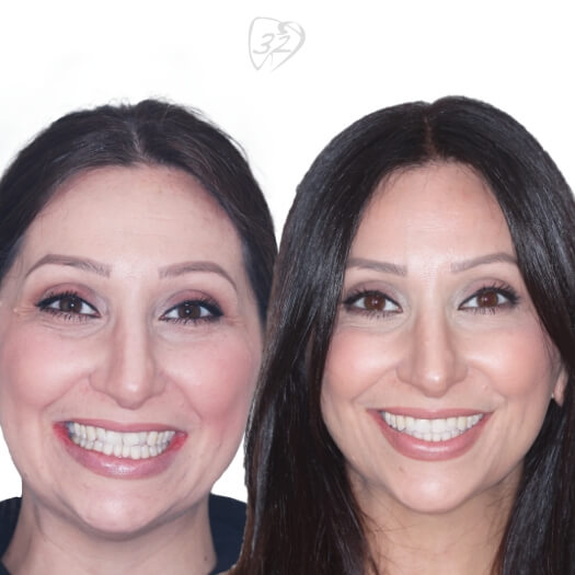 Beyond 32 Dental Before and after case 5 - Tamara