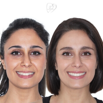 Beyond 32 Dental Before and after case 6 - Tandis