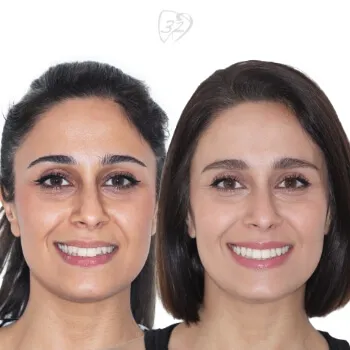 Beyond 32 Dental Before and after case 6 - Tandis