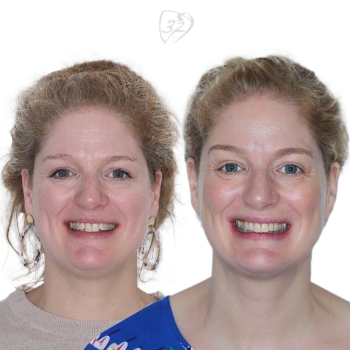 Beyond 32 Dental Before and after case 7 - Anna Wetzel