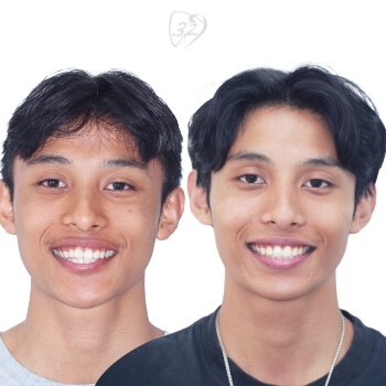 Beyond 32 Dental Before and after case 8 - Benjamin E