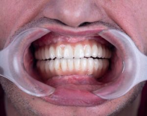 Does Gingivitis Cause Bad Breath check