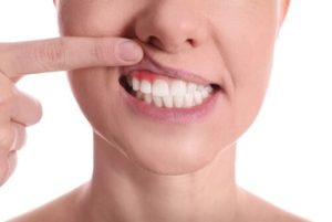 Does Gingivitis Cause Bad Breath receding