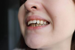 overbite treatment profile