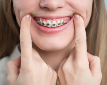 braces before and after