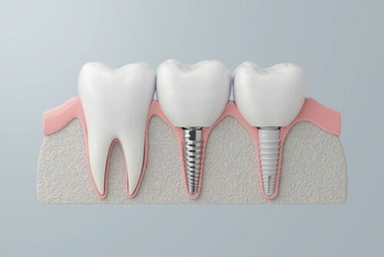 how to relieve pain from dental implant procedure