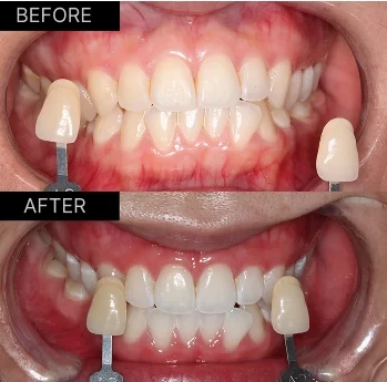 Beyond 32 Dental Teeth Whitening - Before and after case 3