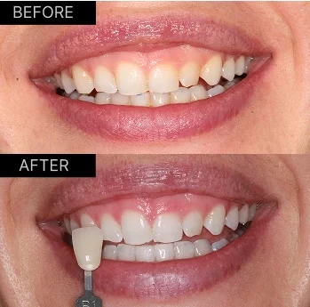 Beyond 32 Dental Teeth Whitening - Before and after case 4