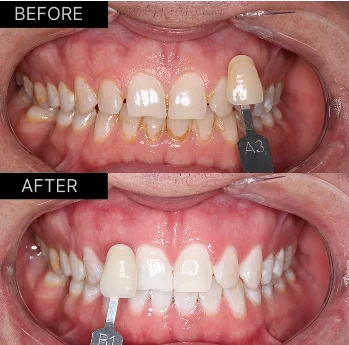 Beyond 32 Dental Teeth Whitening - Before and after case 1