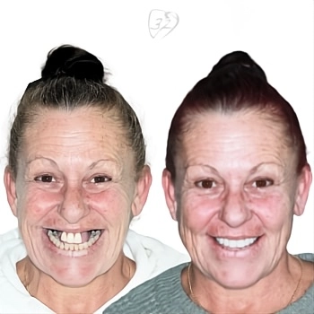 Beyond 32 Dental Before and after case 1 Belinda F