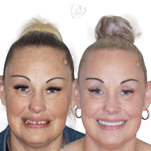 Beyond 32 Dental Before and after case 5 Leigh Jones
