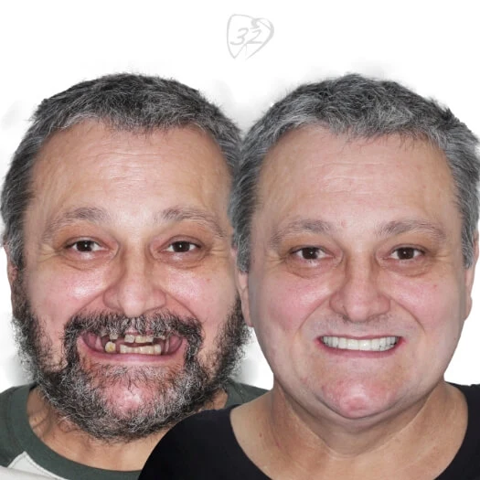 Beyond 32 Dental Before and after case 6 Lupco Serafimovski