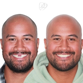 Beyond 32 Dental Before and after case 7 Roy