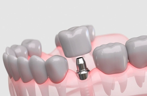 Dental Implant Healing Stages application