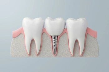 Dental Implant Healing Stages expectation