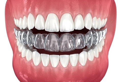 Nighttime Clear Aligners wear