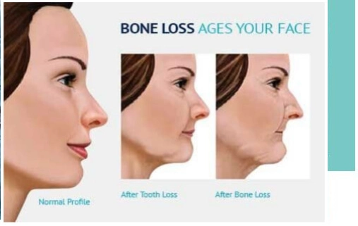 Bone Loss
