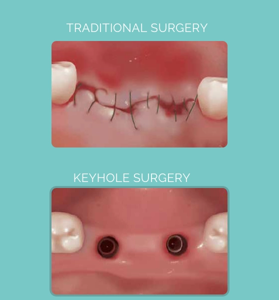 Traditional Surgery