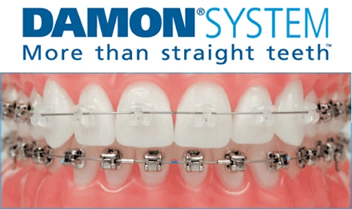 Damon Braces Beyond 32 Dental