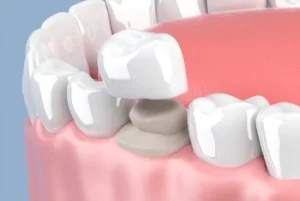 Close-up of a dental crown placed on a molar