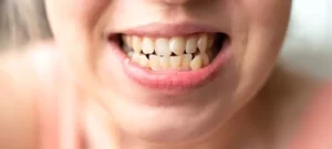 patient showing crooked bottom teeth
