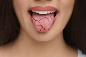 Does Plaque Cause Bad Breath dry