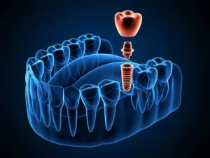 3D illustration of a dental implant, abutment, and crown in a jawbone cross-section.