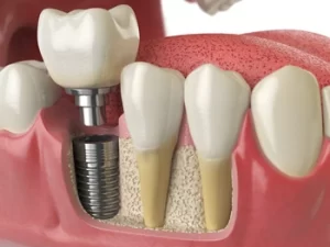 Before and after photo of a patient's smile, showing the replacement of a missing front tooth with a natural-looking implant crown