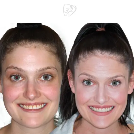 Beyond 32 Dental Before and after case 2 -Emily Page
