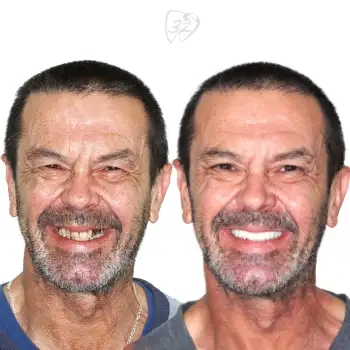 Beyond 32 Dental Before and after case 3 David Warn