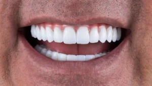 Does Teeth Whitening Hurt results