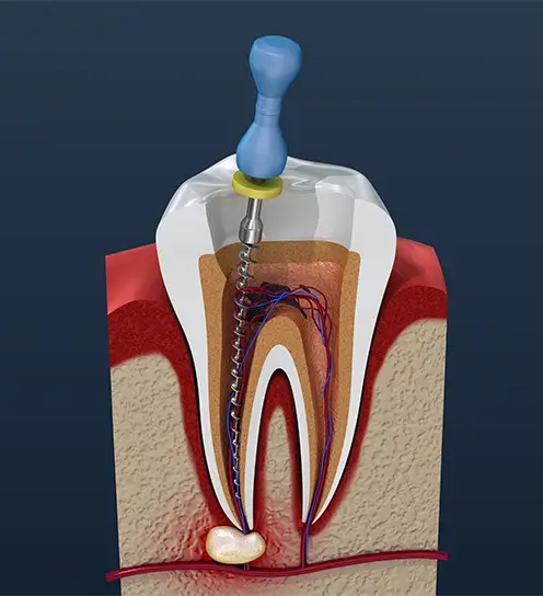 Cross-section illustration of a tooth during a root canal procedure. A dental instrument is within the tooth, highlighting nerves and tissue inside.