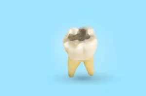 What Does a Tooth Cavity Look Like decay