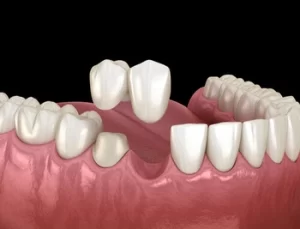 What is a Bridge in Dental Work gap