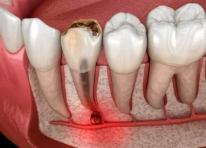 illustration of a Tiny Black Spot on Tooth