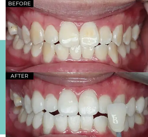 Before and after image showing teeth transformation. Top row: discolored teeth with gaps. Bottom row: whitened, aligned teeth with a shade guide.